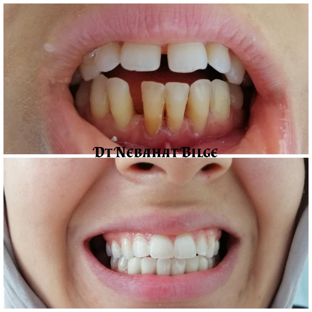 Ortodontik Tedavi ile Diş Düzeltme - Dt. Nebahat Bilge